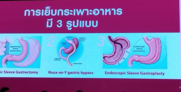บำรุงราษฎร์โชว์นวัตกรรมส่องกล้องเย็บกระเพาะอาหารลดอ้วน