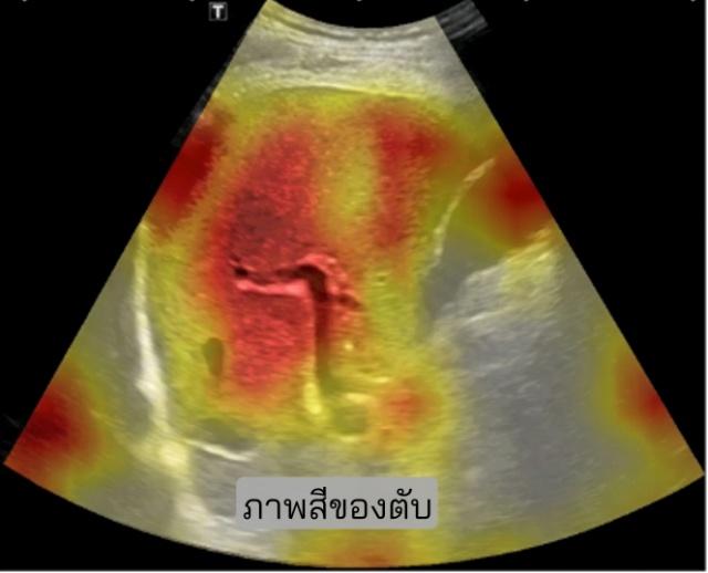 SmartLivaตรวจรู้ผลตับใน7วินาทีฝีมือเด็ก มจธ.